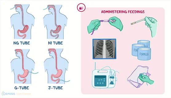 illustration of ng, ni, g, and j feeding tubes with administering feedings tools (syringe, x-ray, formula, pump) demonstrating flush and feed technique